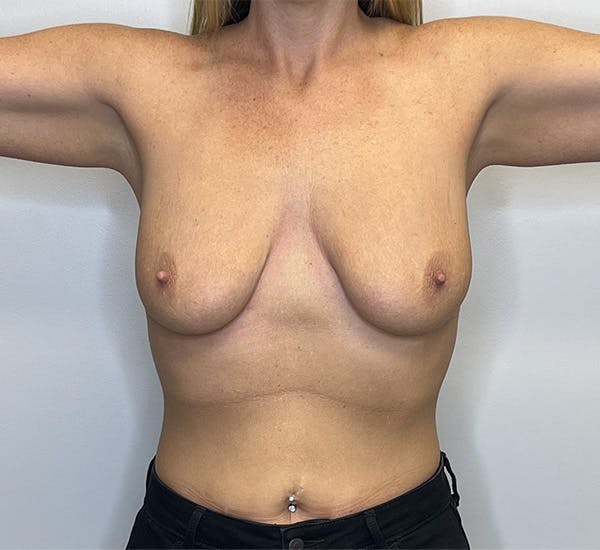 Liposuction Before & After Gallery - Patient 142991665 - Image 1