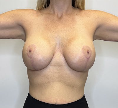 Liposuction Before & After Gallery - Patient 142991665 - Image 2