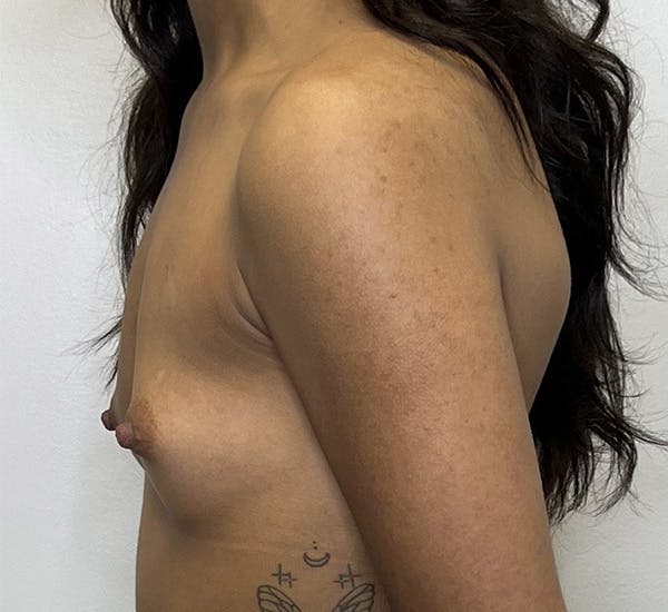 Breast Augmentation Before & After Gallery - Patient 143250389 - Image 5