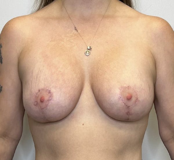 Breast Augmentation with Mastopexy Before & After Gallery - Patient 143250424 - Image 2