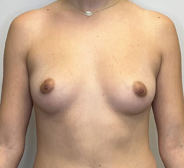 Breast Augmentation Before & After Gallery - Patient 143651028 - Image 1