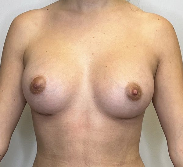 Breast Augmentation Before & After Gallery - Patient 143651028 - Image 2