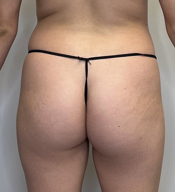Brazilian Butt Lift Before & After Gallery - Patient 143745052 - Image 1