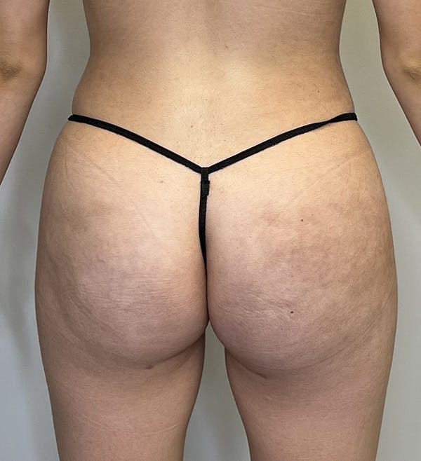 Brazilian Butt Lift Before & After Gallery - Patient 143745052 - Image 2