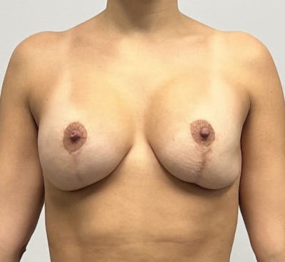 Breast Revision Surgery Before & After Gallery - Patient 143745319 - Image 1