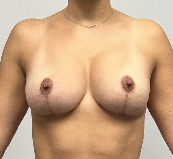 Breast Lift Before & After Gallery - Patient 143745321 - Image 2