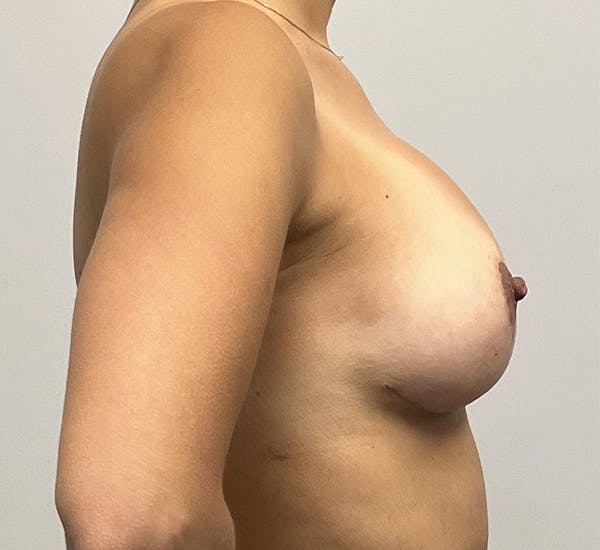 Breast Revision Surgery Before & After Gallery - Patient 143745319 - Image 6
