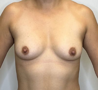 Breast Augmentation Before & After Gallery - Patient 143823342 - Image 1