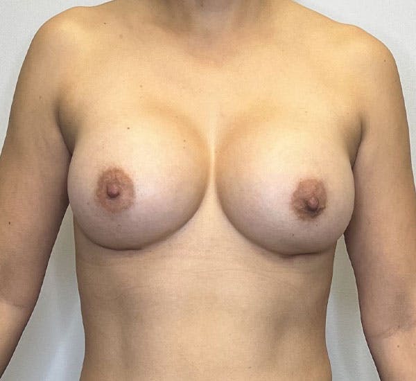 Breast Augmentation Before & After Gallery - Patient 143823342 - Image 2