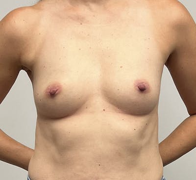 Breast Augmentation Before & After Gallery - Patient 144196890 - Image 1