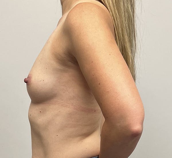 Breast Augmentation Before & After Gallery - Patient 144196890 - Image 5