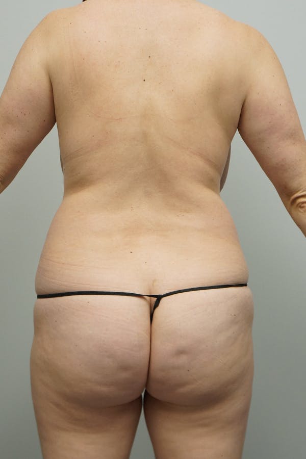 Liposuction Before & After Gallery - Patient 144197807 - Image 5