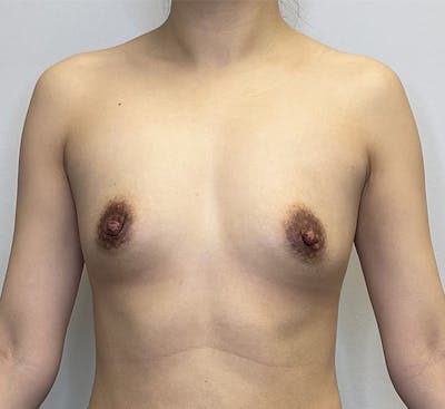 Breast Augmentation Before & After Gallery - Patient 144271685 - Image 1