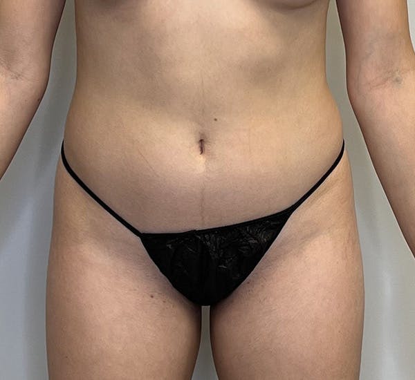 High-Definition Liposuction Before & After Gallery - Patient 144296693 - Image 1