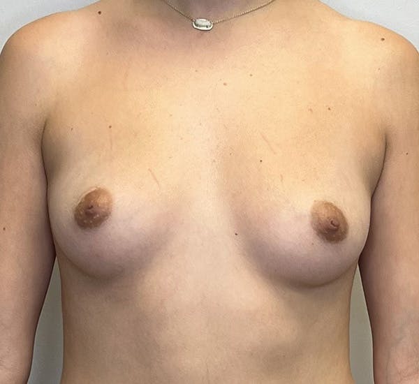 Breast Augmentation Before & After Gallery - Patient 144296698 - Image 1