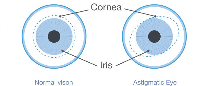 Astigmatism infographic