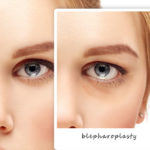 New York Laser Vision Blog | Blepharoplasty Can Restore Your Face’s Youthful Appearance