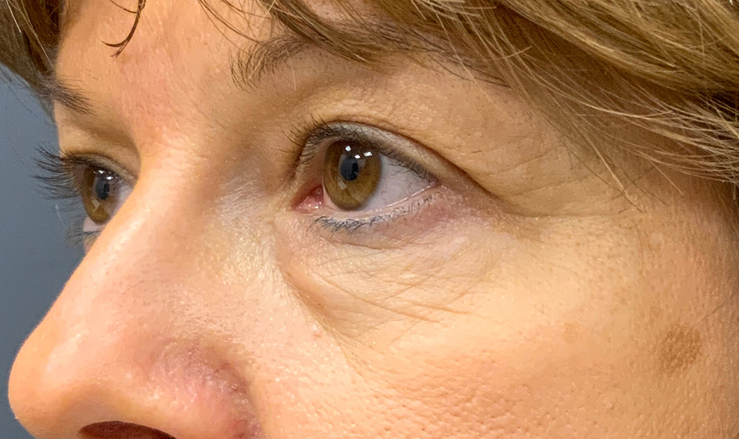 before and after blepharoplasty