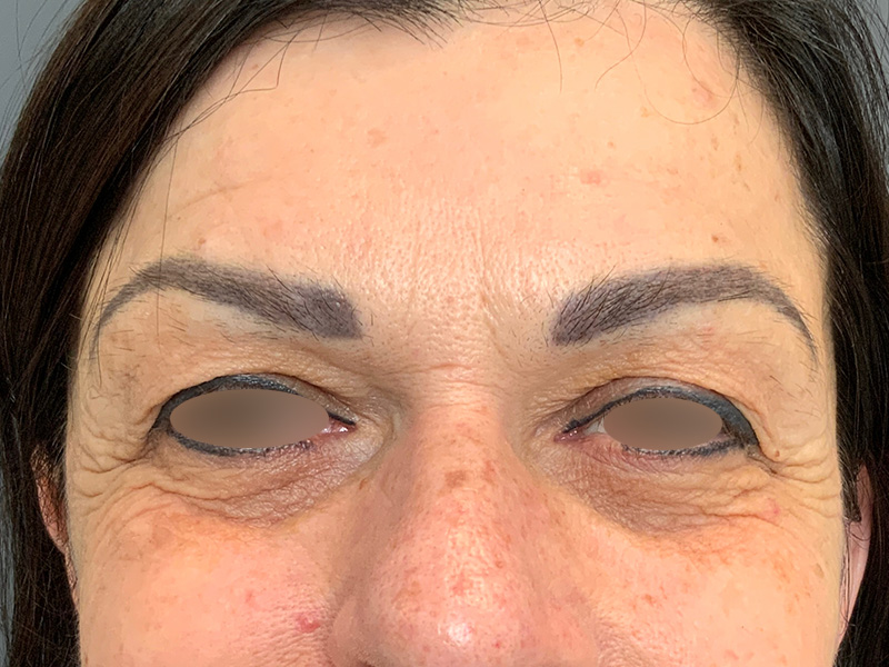 before and after blepharoplasty