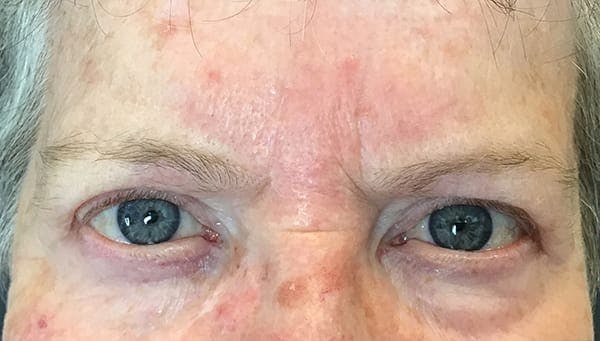 Blepharoplasty Before & After Gallery - Patient 330586 - Image 2