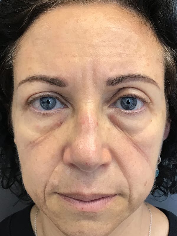 Dermal Fillers Before & After Gallery - Patient 314048 - Image 1