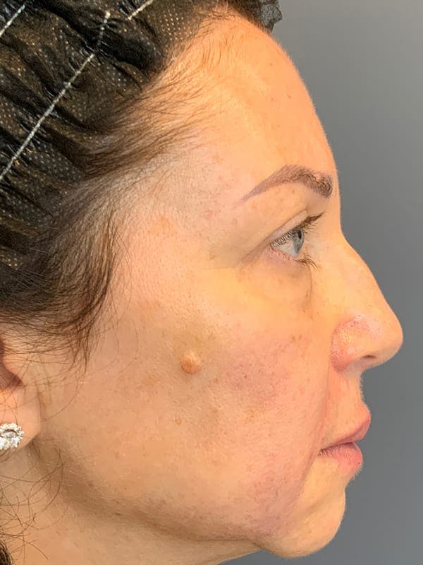 Dermal Fillers Before & After Gallery - Patient 314048 - Image 10