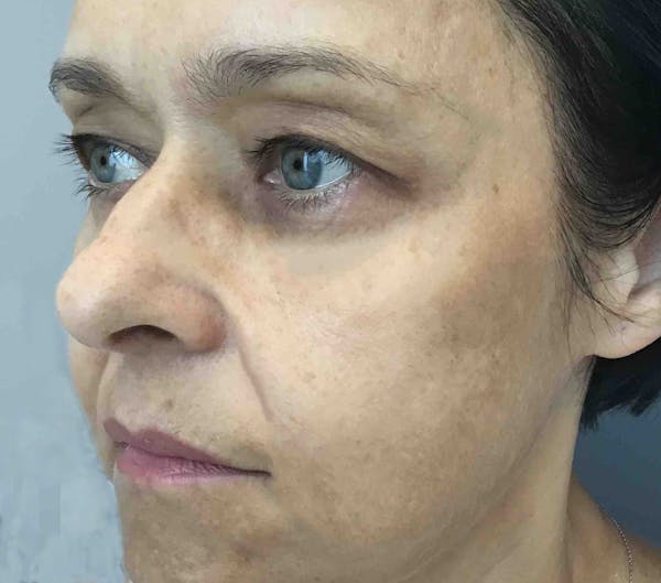 Dermal Fillers Before & After Gallery - Patient 245912 - Image 2