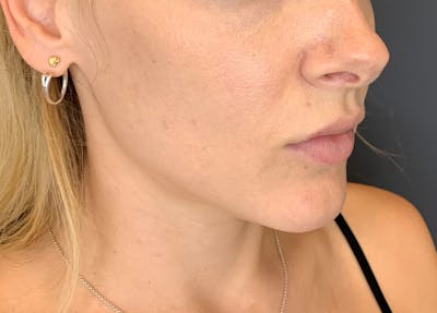 Dermal Fillers Before & After Gallery - Patient 144303 - Image 2