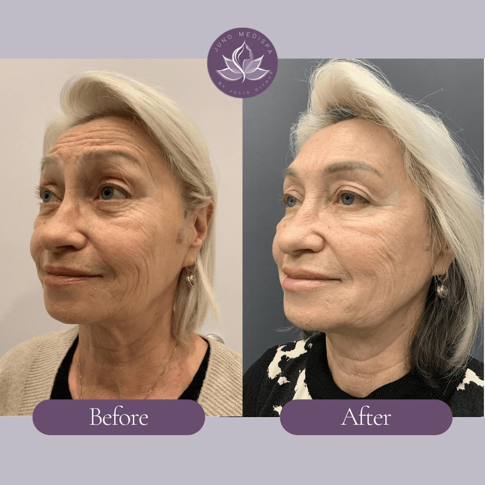Botox Before & After Gallery - Patient 182185 - Image 3