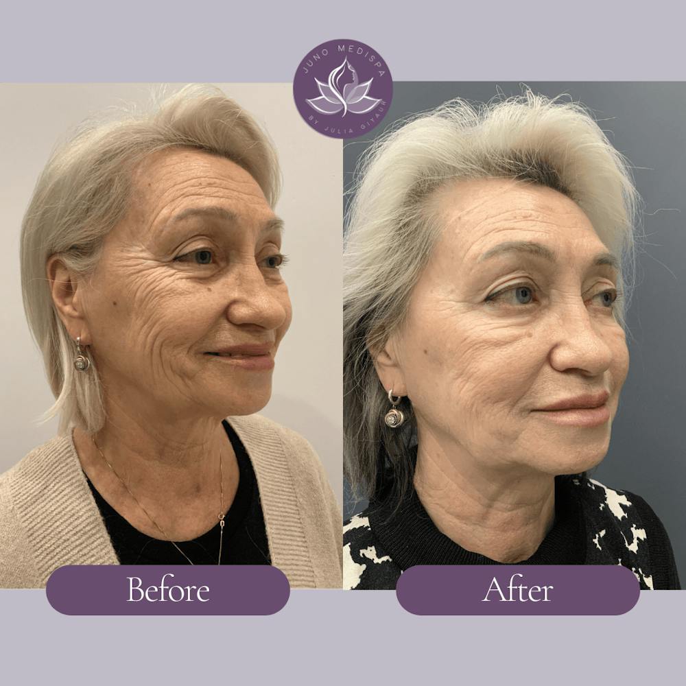 Botox Before & After Gallery - Patient 182185 - Image 2