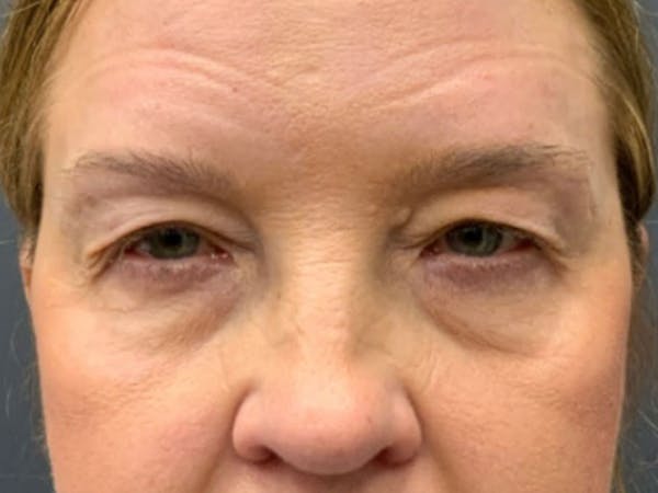 Blepharoplasty Before & After Gallery - Patient 661997 - Image 1