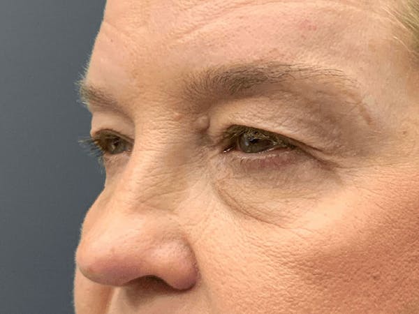 Blepharoplasty Before & After Gallery - Patient 661997 - Image 3