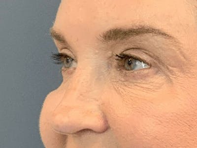 Blepharoplasty Before & After Gallery - Patient 661997 - Image 4