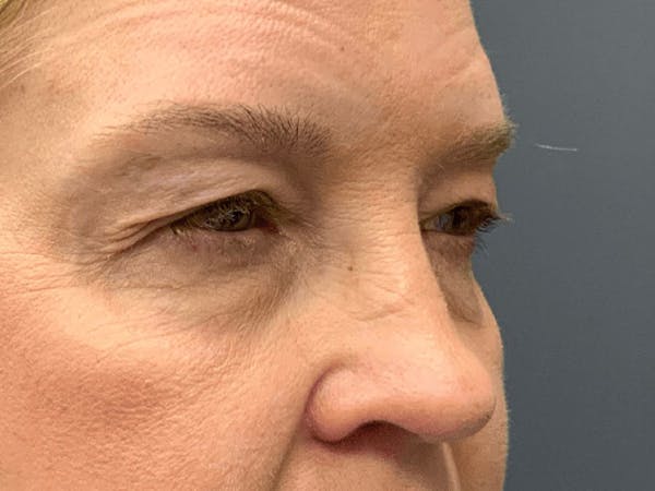 Blepharoplasty Before & After Gallery - Patient 661997 - Image 5