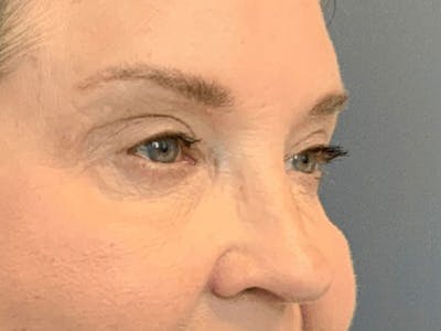 Blepharoplasty Before & After Gallery - Patient 661997 - Image 6
