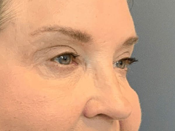 Blepharoplasty Before & After Gallery - Patient 661997 - Image 6