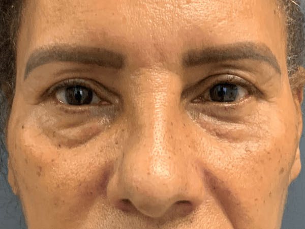 Blepharoplasty Before & After Gallery - Patient 248666 - Image 1