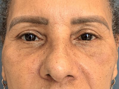 Blepharoplasty Before & After Gallery - Patient 248666 - Image 2