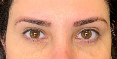 Blepharoplasty Before & After Gallery - Patient 255150 - Image 2