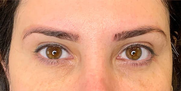 Blepharoplasty Before & After Gallery - Patient 255150 - Image 2