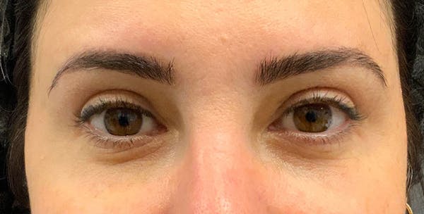 Blepharoplasty Before & After Gallery - Patient 255150 - Image 1