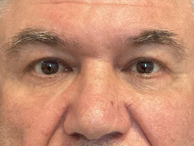 Blepharoplasty Before & After Gallery - Patient 195681 - Image 2