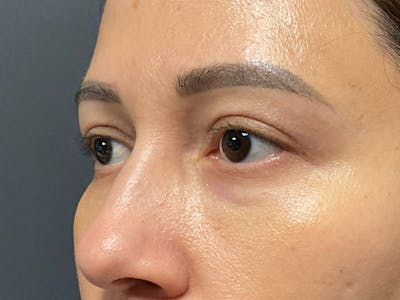Blepharoplasty Before & After Gallery - Patient 113847 - Image 6
