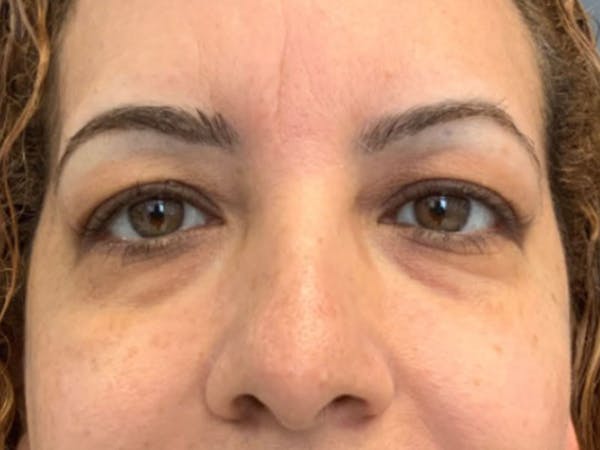 Blepharoplasty Before & After Gallery - Patient 700465 - Image 3