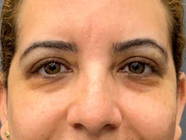 Blepharoplasty Before & After Gallery - Patient 700465 - Image 4