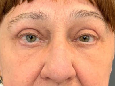 Blepharoplasty Before & After Gallery - Patient 544355 - Image 2
