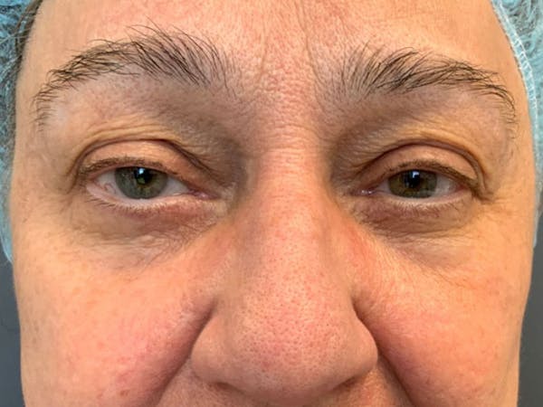 Blepharoplasty Before & After Gallery - Patient 544355 - Image 3