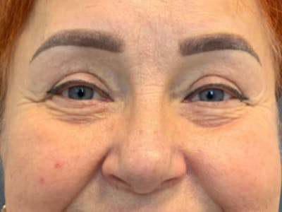 Blepharoplasty Before & After Gallery - Patient 396684 - Image 2