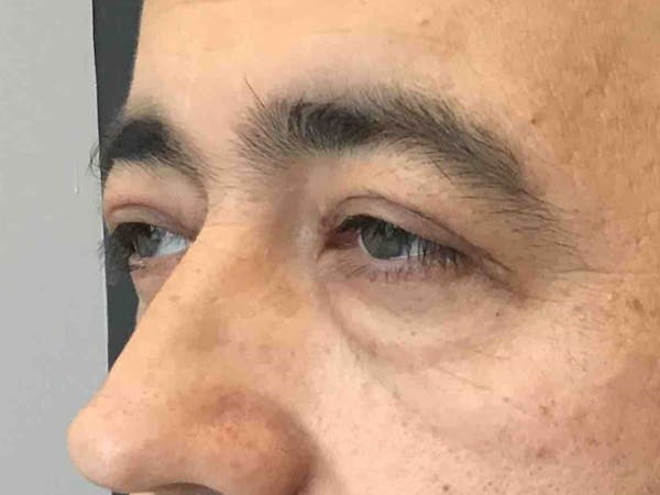 Blepharoplasty Before & After Gallery - Patient 427209 - Image 2