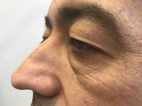Blepharoplasty Before & After Gallery - Patient 427209 - Image 3
